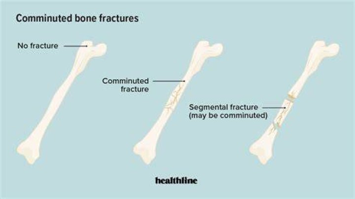 Are comminuted fracture considered displaced?