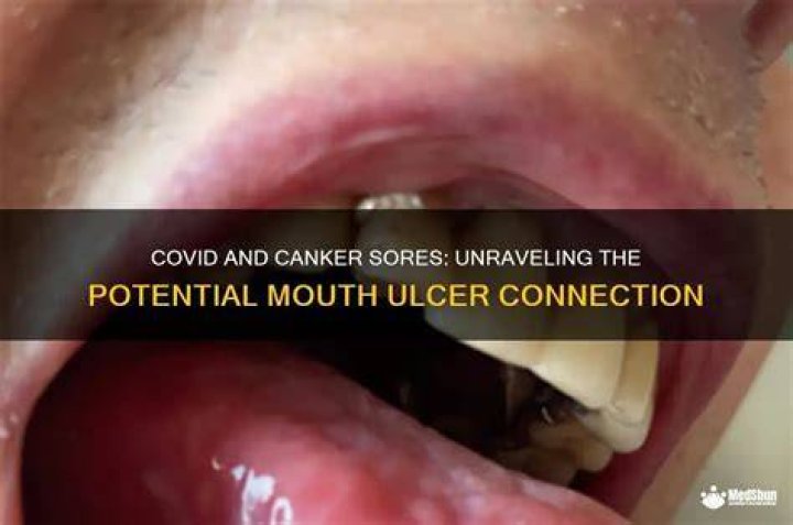 Are sores in the mouth a sign of covid?