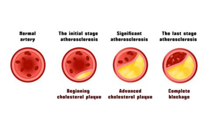 Can arterial plaque be reversed?
