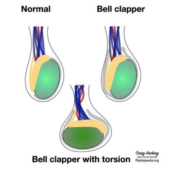 Can bell clapper deformity cause infertility?