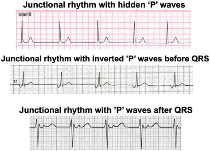 Does atropine work on junctional rhythms?