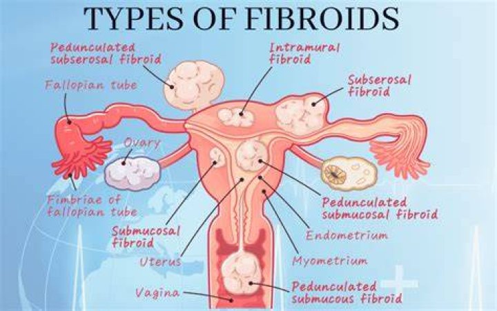 Does fibroids cause pain?