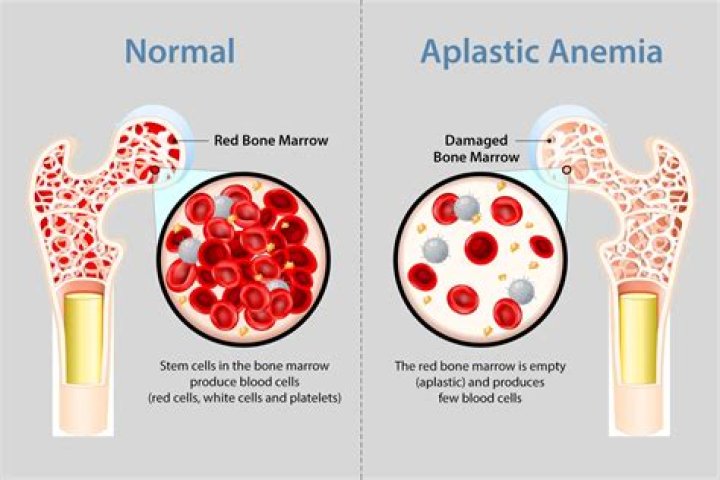 Does phenytoin cause aplastic anemia?