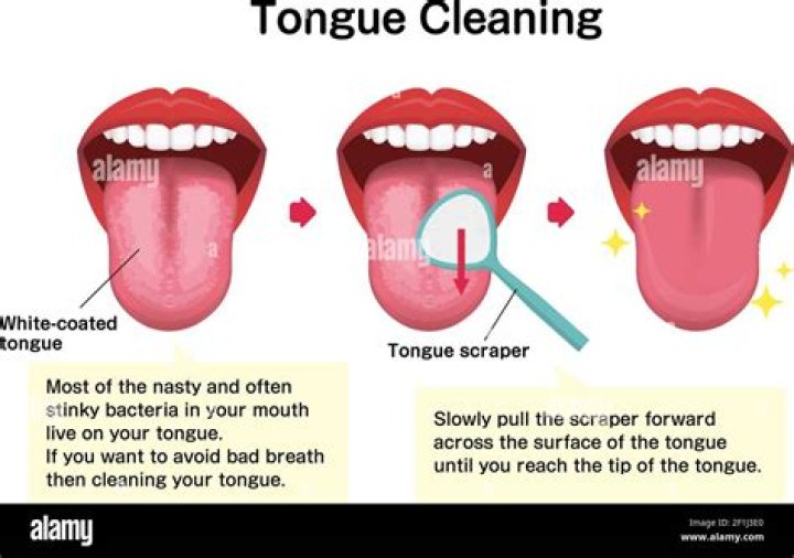 How to clean white tongue?