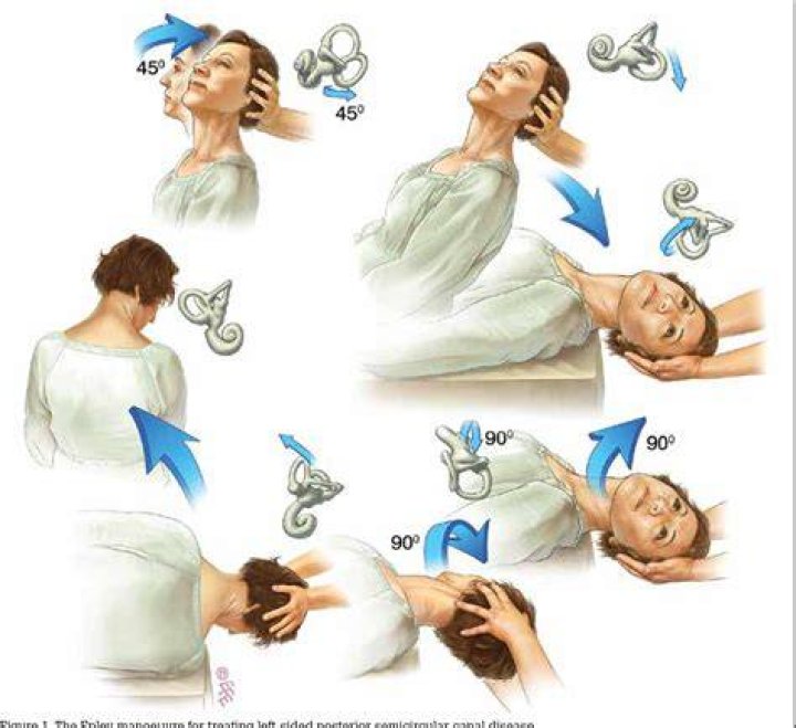 Should epley maneuver be repeated?
