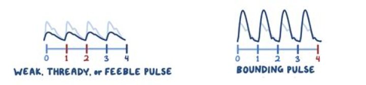 What does a thready pulse feel like?