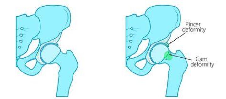 What is a cam deformity of the hip?