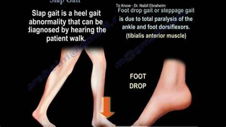 What is high stepping gait?
