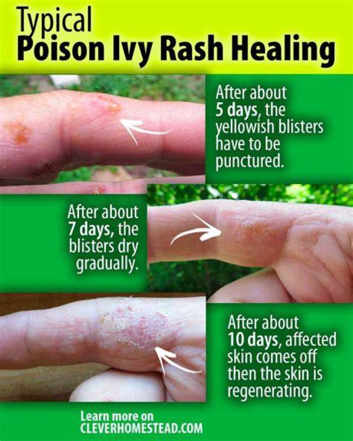 When poison ivy blisters pop?