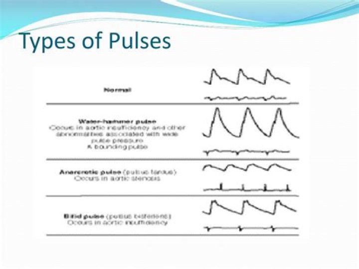 Where do you find thready pulse?