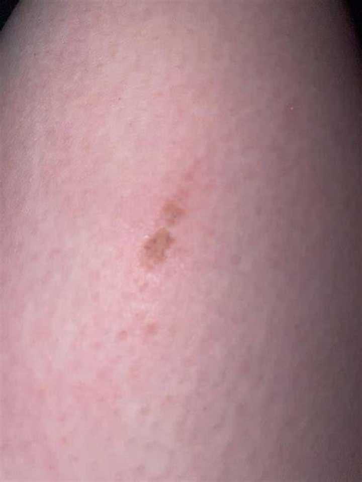 Will friction burn scar?